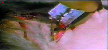 Eyeball slice from New York Ripper
